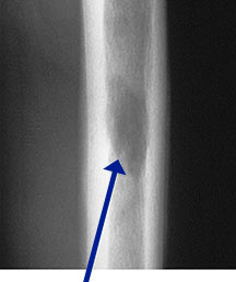 eosinophilic granuloma tumors of the bone eosinophilic granuloma