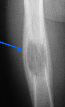 eosinophilic granuloma tumors of the bone eosinophilic granuloma