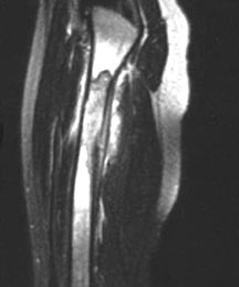 eosinophilic granuloma tumors of the bone eosinophilic granuloma
