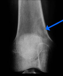 eosinophilic granuloma tumors of the bone eosinophilic granuloma