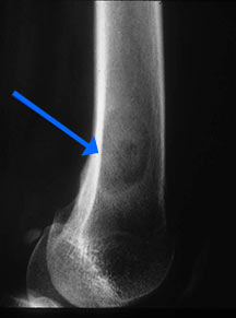 eosinophilic granuloma tumors of the bone eosinophilic granuloma