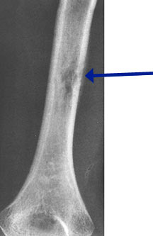 eosinophilic granuloma tumors of the bone eosinophilic granuloma