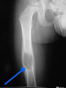 Radiology, Permeative with periosteal reaction 