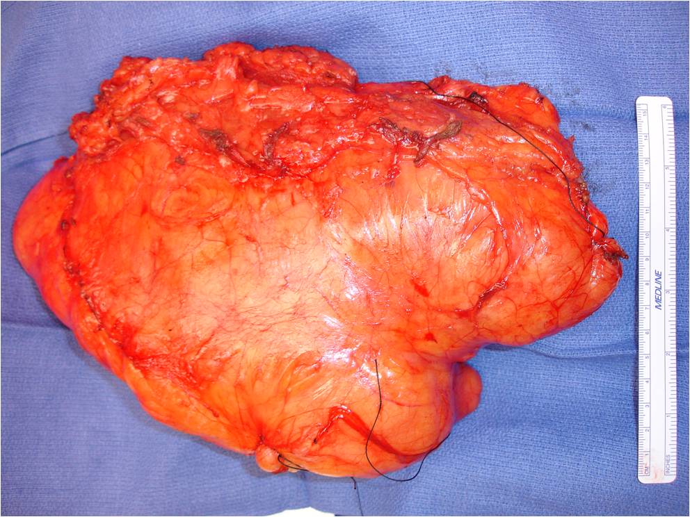 fatty tumor tumor surgery bone cancer tumors sarcoma surgeon nyc fatty tumor tumor surgery bone cancer tumors sarcoma surgeon nyc