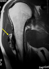 AP/scapular Y view radiograph: