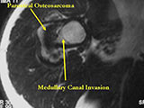 AP/scapular Y view radiograph: