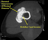 AP/scapular Y view radiograph: