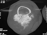 CT Scan and lateral radiograph: