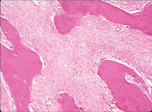 H&E slides, low and high magnification: parosteal osteosarcoma