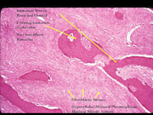 H&E slides, low and high magnification: parosteal osteosarcoma