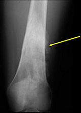 AP/lateral radiograph: Parosteal osteosarcoma of posterior distal femur