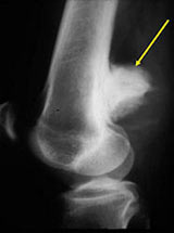 Lateral radiograph and CT: Parosteal osteosarcoma of distal femur