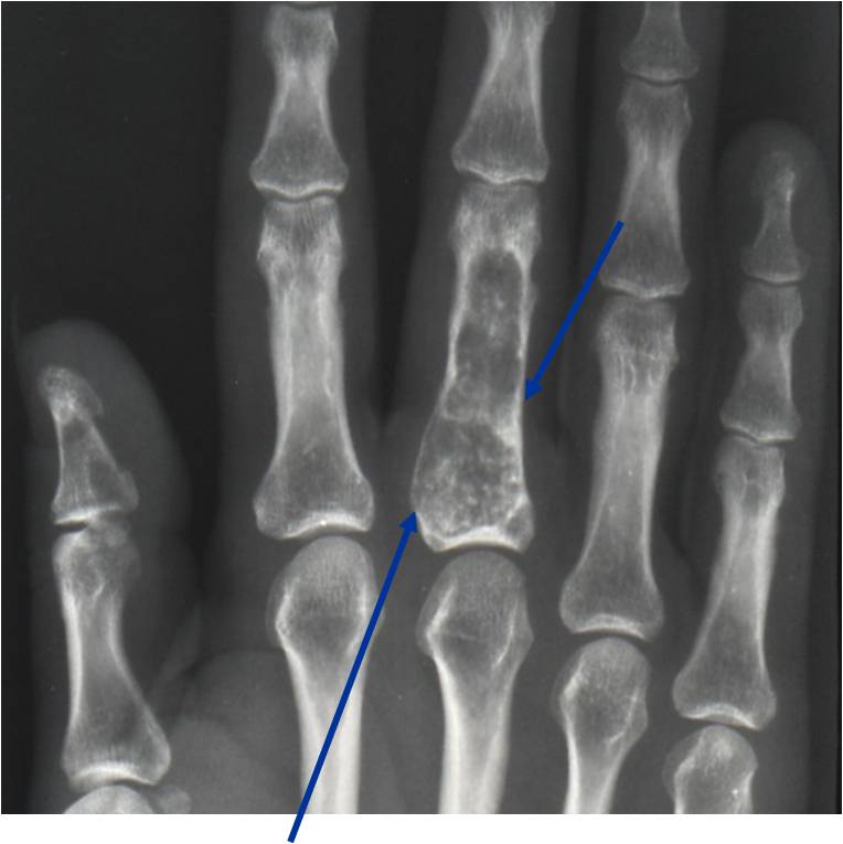 hyaline cartilage