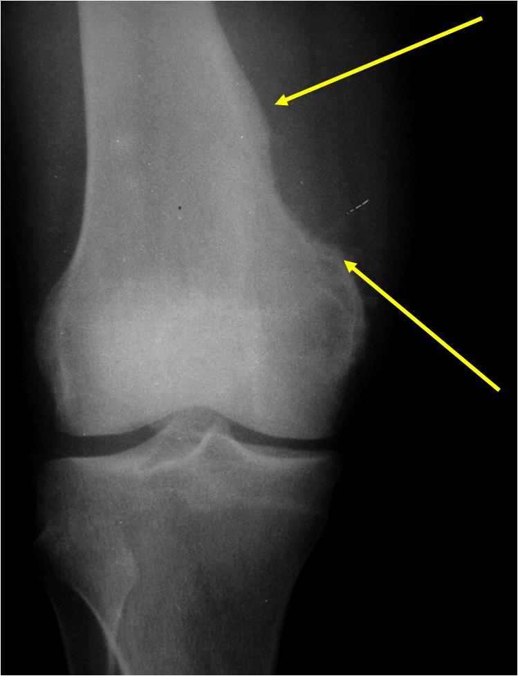osteosarcoma cancer and tumor El osteosarcoma es un tumor maligno y primario del hueso, el cual es el más frecuente de este tipo se caracteriza por formación de osteoide lee para saber. osteosarcoma cancer and tumor El osteosarcoma es un tumor maligno y primario del hueso, el cual es el más frecuente de este tipo se caracteriza por formación de osteoide lee para saber.