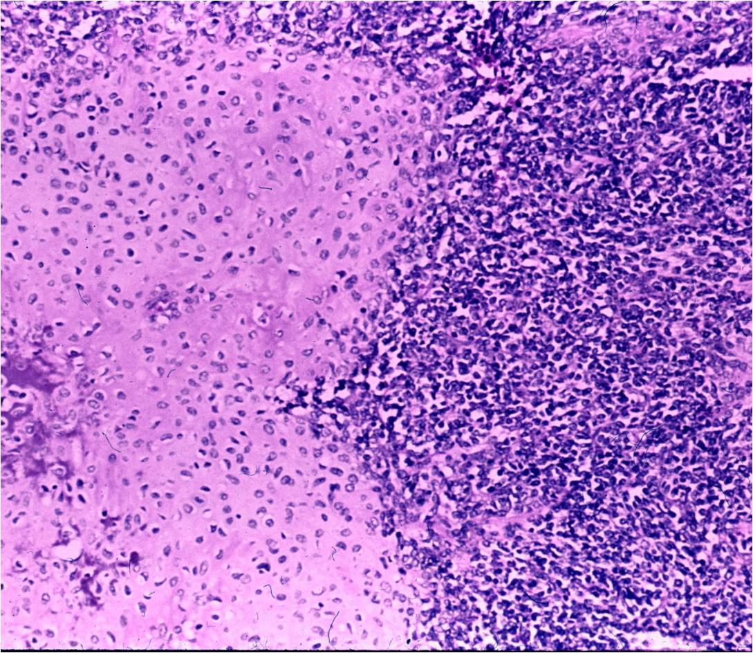 Mesenchymal Chondrosarcoma, microscopic pathology