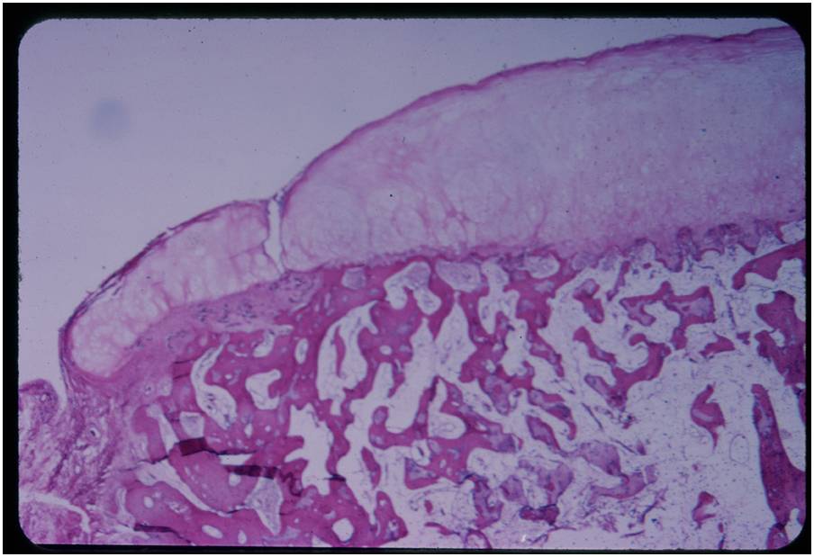 Hyaline cartilage cap overlying medullary bone