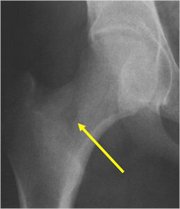Xray: Intramedullary Osteoid Osteoma of Proximal Femur