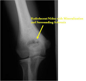 X-ray: Osteoid Osteoma of Distal Humerus Olecranon Fossa
