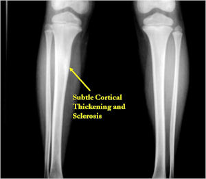 X-Ray: Osteoid Osteoma of Tibia