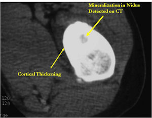 CT Scan: Osteoid Osteoma