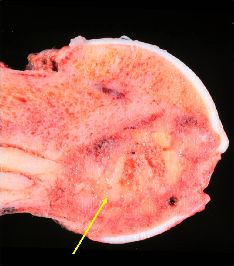 透明细胞软骨肉瘤 clear cell chondrosarcoma