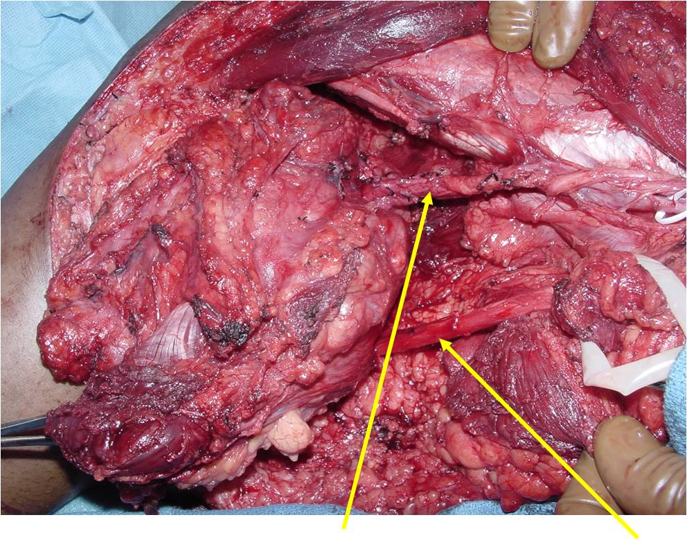 portion of popliteal artery removed with tumor, sciatic nerve