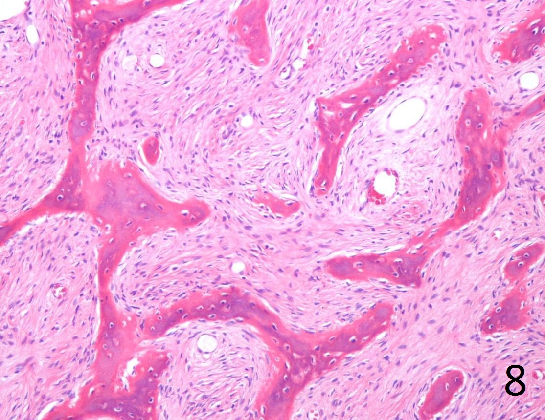 Fig. 8. Microscopic: Low power photograph of fibrous dysplasia shows a combination of bland fibrous tissue with small fragments of woven bone. The lesion is hypocellular with small uniform fibroblasts. There are spicules of bone that are not lined by osteoblasts. Fig. 8. Microscopic: Low power photograph of fibrous dysplasia shows a combination of bland fibrous tissue with small fragments of woven bone. The lesion is hypocellular with small uniform fibroblasts. There are spicules of bone that are not lined by osteoblasts.