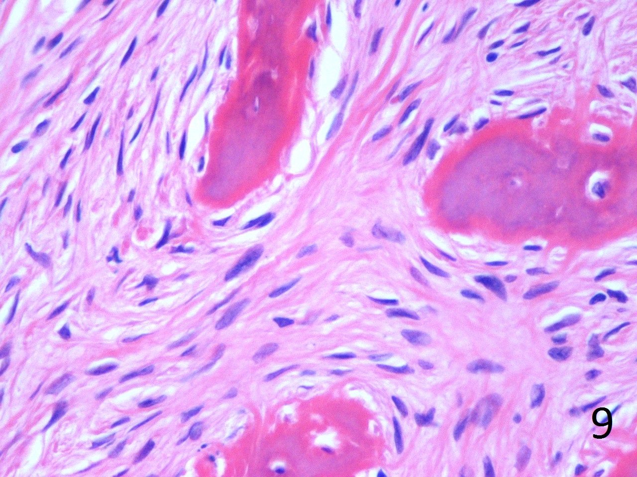 Fig. 9. High power photograph of pathology of fibrous dysplasia shows woven bone being produced by the fibrous tissue. There are no osteoblasts lining the bone. Fig. 9. High power photograph of pathology of fibrous dysplasia shows woven bone being produced by the fibrous tissue. There are no osteoblasts lining the bone.