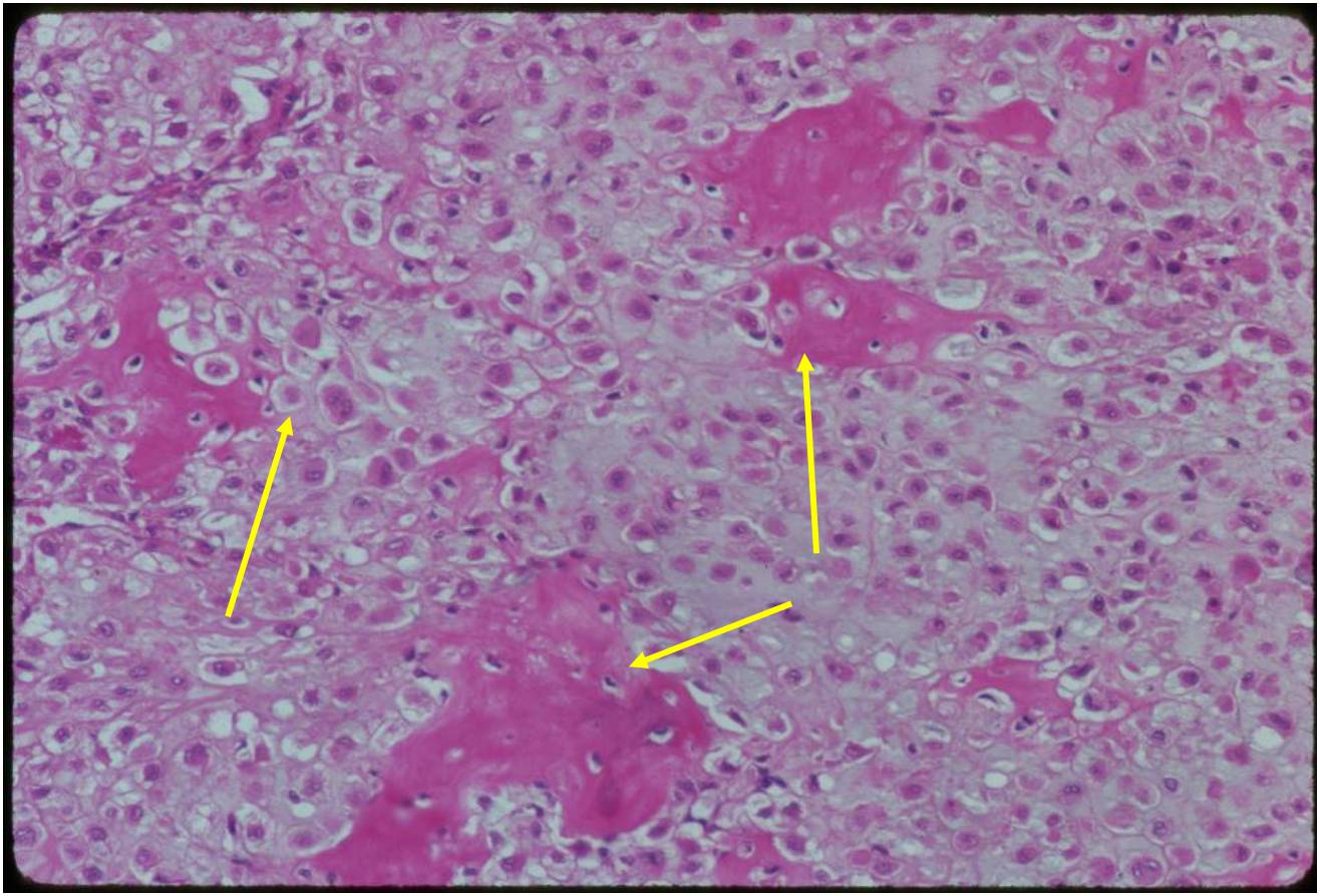pathology: clear cell chondrosarcoma pathology: clear cell chondrosarcoma