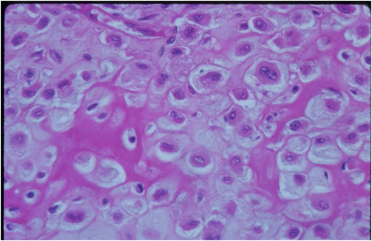 pathology: clear cell chondrosarcoma pathology: clear cell chondrosarcoma