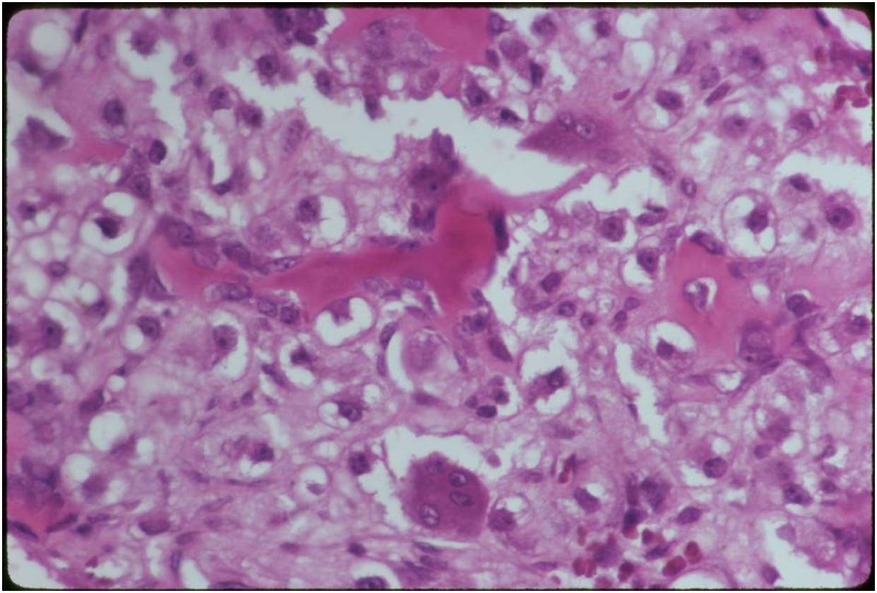 pathology: clear cell chondrosarcoma pathology: clear cell chondrosarcoma