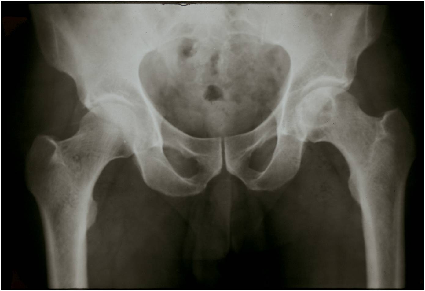 AP pelvis radiograph AP pelvis radiograph