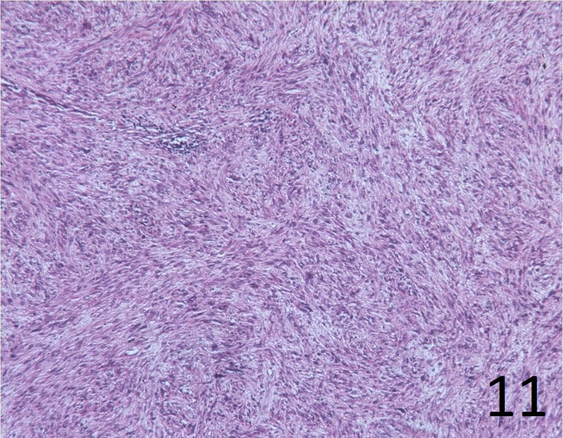 Fig. 11: Microscopic: Low power magnification H&E shows a spindle cell sarcoma with a typical herringbone pattern.