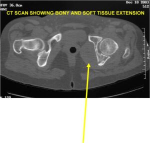 CT and MRI: Dedifferentiated Chondrosarcoma of Left Acetabulum