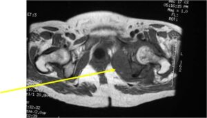 MRI: Dedifferentiated Chondrosarcoma of Left Acetabulum