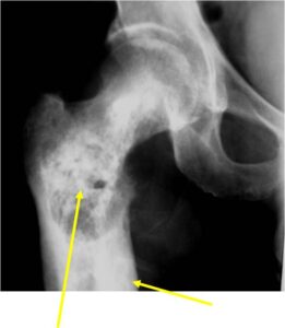 Plain X-ray: Dedifferentiated Chondrosarcoma of Proximal Femur Cortical Thickening High Grade, Lytic Dedifferentiated Sarcoma Component Cortical Destruction Soft Tissue Extension