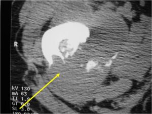CT Scan: Dedifferentiated Chondrosarcoma of Proximal Femur Cortical Destruction and Soft Tissue Extension