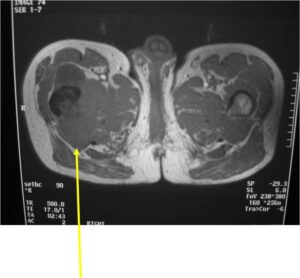 MRI: Dedifferentiated Chondrosarcoma of Proximal Femur TI Weighted Image Cortical Destruction and Soft Tissue Extension
