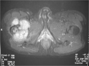 MRI: Dedifferentiated Chondrosarcoma of Proximal Femur T2 Weighted Image