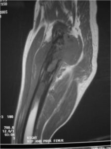 MRI: Dedifferentiated Chondrosarcoma of Proximal Femur