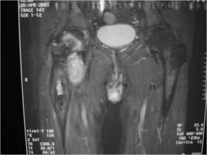 MRI: Dedifferentiated Chondrosarcoma of Proximal Femur