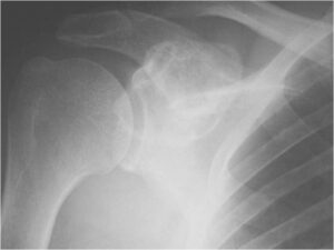 X-ray and CT Scan: Dedifferentiated Chondrosarcoma of Scapula