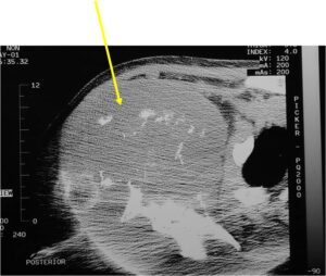 X-ray and CT Scan: Dedifferentiated Chondrosarcoma of Scapula Large Soft Tissue Mass from Scapula Calcifications