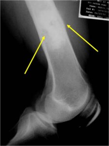 Dedifferentiated Chondrosarcoma of Distal Femur with Minimal Cortical Destruction and Soft Tissue Extension (Very Rare Presentation) Minimal Cortical Destruction
