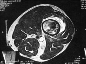 MRI: Dedifferentiated Chondrosarcoma of Distal Femur with Minimal Cortical Destruction and Soft Tissue Extension (Very Rare Presentation)