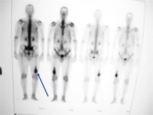 Bone Scan: Dedifferentiated Chondrosarcoma of Distal Femur Intense Uptake on Bone Scan