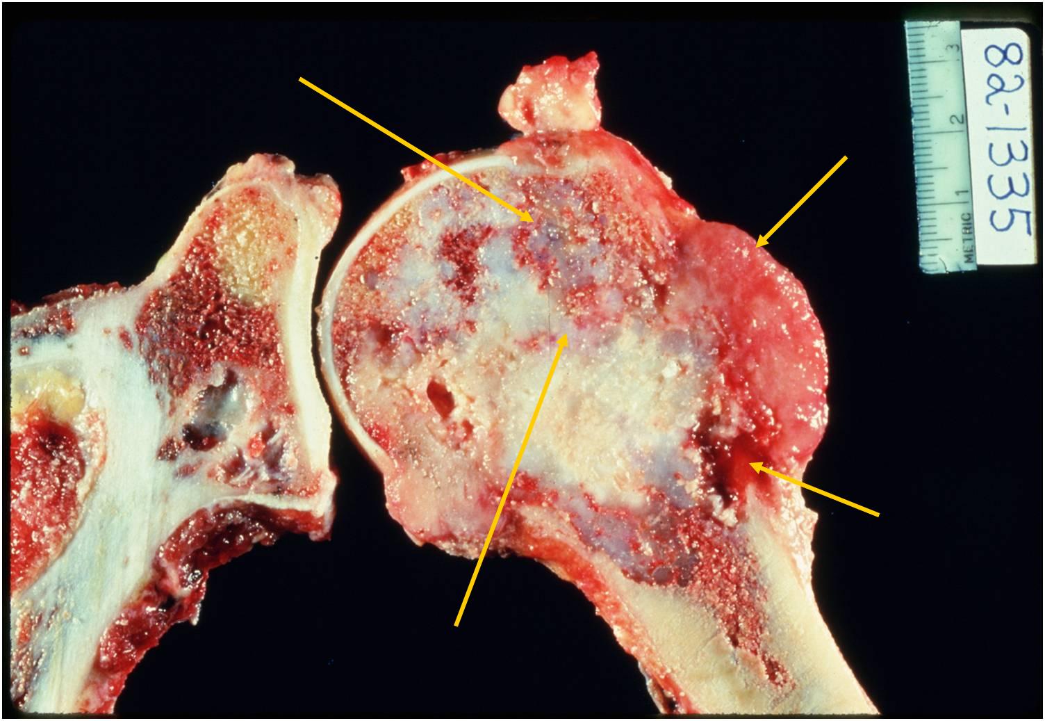 Dedifferentiaed Chondrosarcoma of Distal Humerus