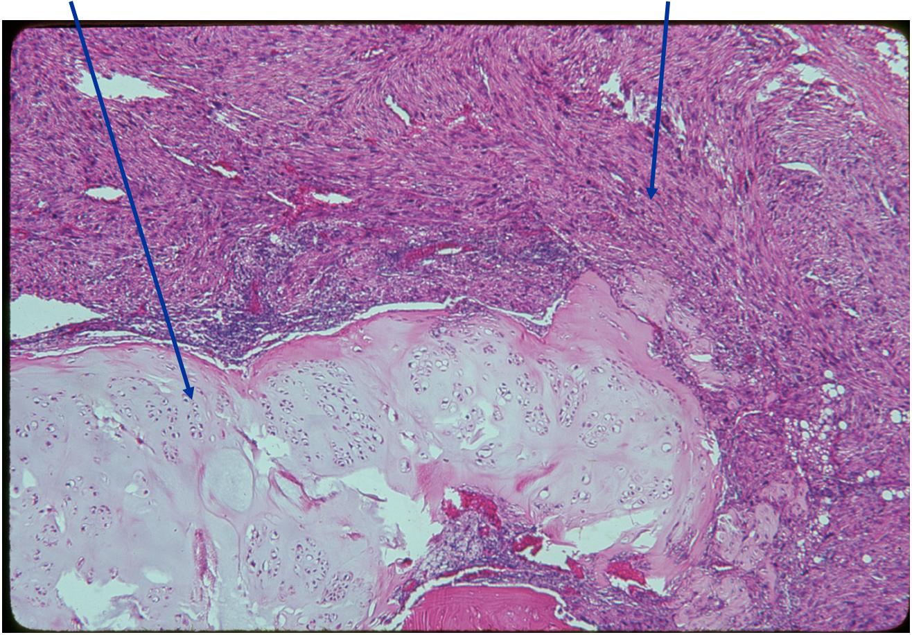 (Left Arrow) Low Grade Cartilage Component
(Right Arrow) Spindle Cell Component