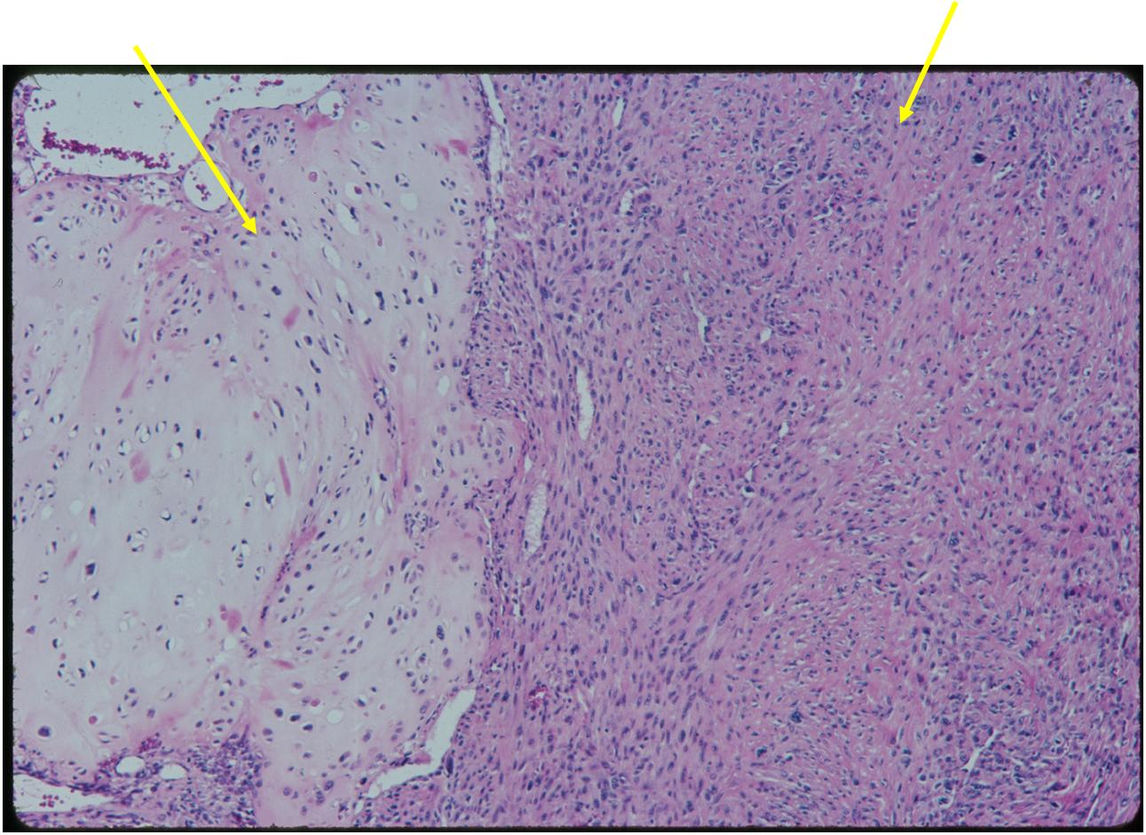 (Left Arrow) Low Grade Cartilage Component
(Right Arrow) Dedifferentiated Component