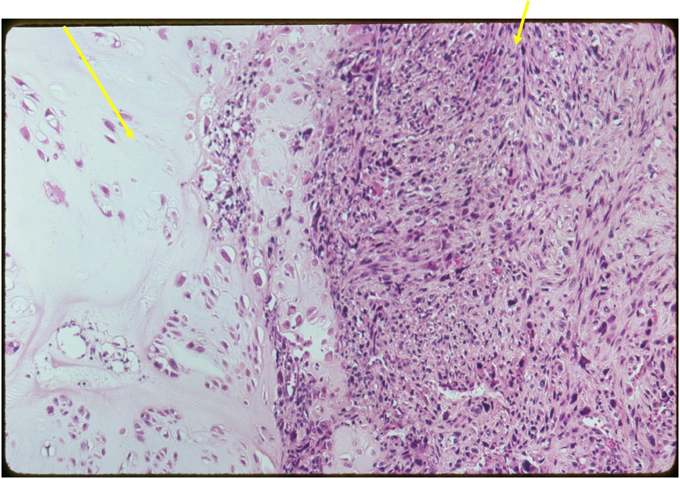 (Left Arrow) Low Grade Cartilage Component
(Right Arrow) Dedifferentiated Component